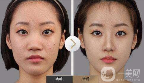 鼻頭縮小手術,多少錢