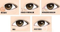 開(kāi)眼角果有哪些、開(kāi)眼角手術(shù)的果怎么樣？