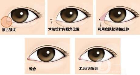 開眼角*果有哪些、開眼角手術(shù)的*果怎么樣？