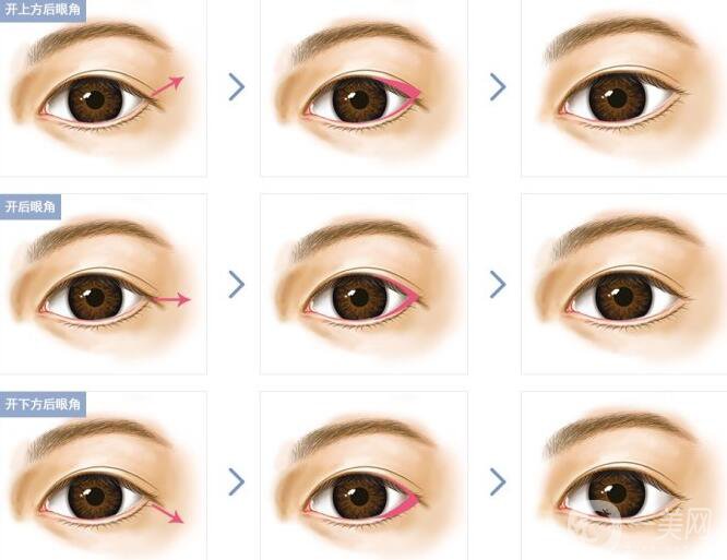 開眼角*果有哪些、開眼角手術(shù)的*果怎么樣？