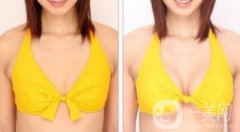 曼托假體隆胸手術(shù)有風(fēng)險(xiǎn)嗎？曼托假體隆胸后遺癥介紹