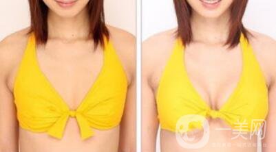 曼托假體隆胸手術(shù)有風(fēng)險嗎？曼托假體隆胸后遺癥介紹