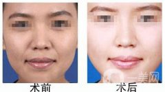 自體脂肪豐鼻唇溝有什么優(yōu)勢(shì)？果怎么樣呢？