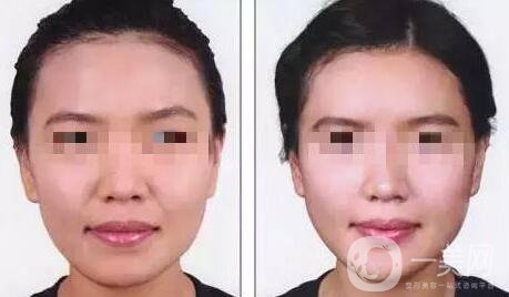 自體脂肪豐鼻唇溝有什么優(yōu)勢(shì)？*果怎么樣呢？