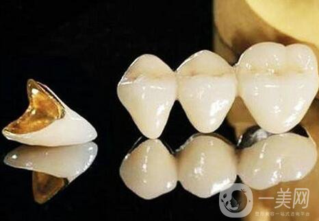 黃金烤瓷牙多少錢一顆？黃金烤瓷牙價(jià)格詳解
