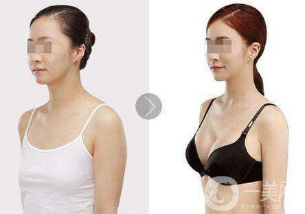 隆胸曼托假體多少錢？曼托假體價格詳解