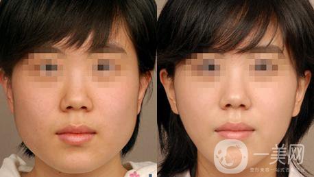 咬肌切除手術(shù)多少錢(qián)？手術(shù)*嗎？