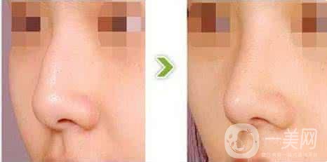 駝峰鼻矯正價(jià)錢一般是多少？