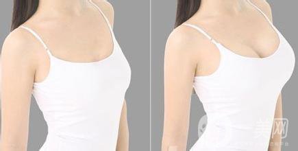 曼托假體豐胸價格大概多少錢？