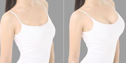 曼托假體豐胸價格大概多少錢？