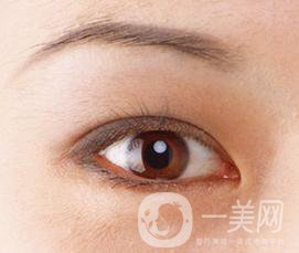 生物焊接雙眼皮是什么？有什么特點(diǎn)？