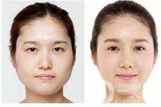 生物焊接雙眼皮是什么？有什么特點(diǎn)？