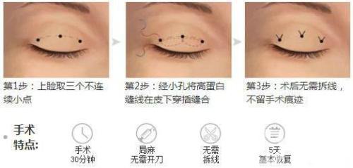 三點式雙眼皮*果一般能撐幾年？