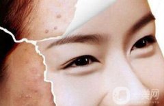光子嫩膚能去痘印嗎、光子嫩膚去痘印果怎么樣？