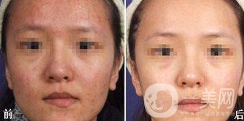 光子嫩膚能去痘印嗎、光子嫩膚去痘印*果怎么樣？