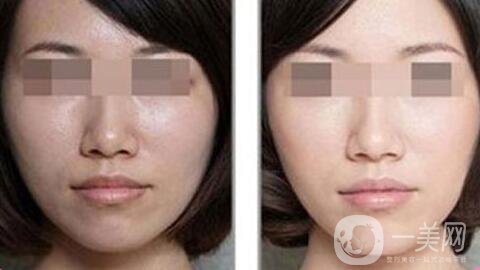 光子嫩膚做一次多少錢、光子嫩膚價(jià)格詳解