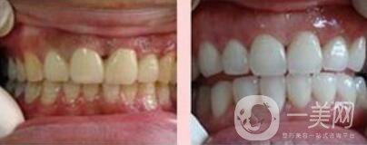 四環(huán)素牙如何變白、四環(huán)素牙怎么調(diào)節(jié)？