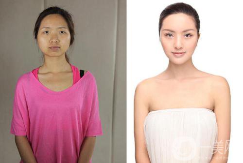 光子嫩膚有些什么*果和好處？