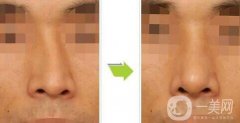 歪鼻矯正需要多少錢(qián)、歪鼻矯正術(shù)的價(jià)格詳解