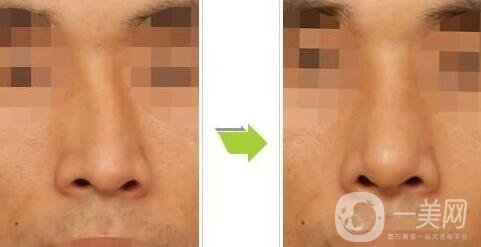 歪鼻矯正需要多少錢、歪鼻矯正術(shù)的價格詳解