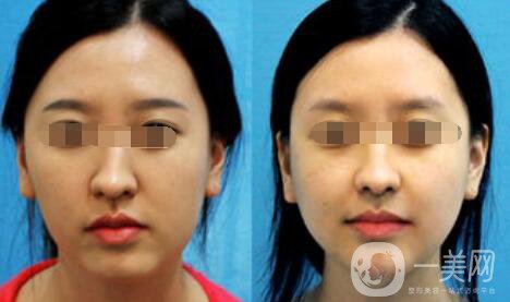 歪鼻矯正需要多少錢、歪鼻矯正術(shù)的價格詳解