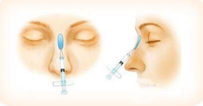 上海注射隆鼻要多少錢？注射隆鼻價錢詳解