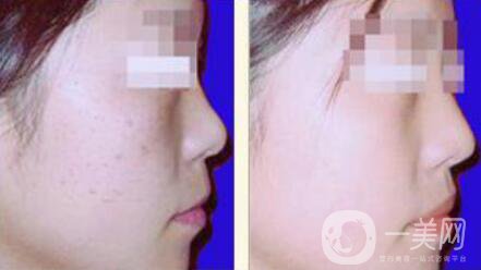 光子嫩膚的*果如何、光子嫩膚到底怎么樣？