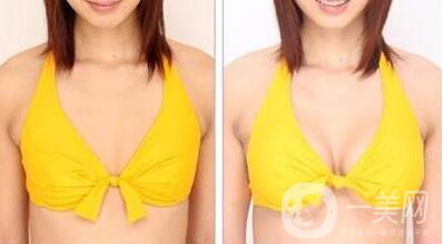 妙桃,假體隆胸,多少錢(qián)