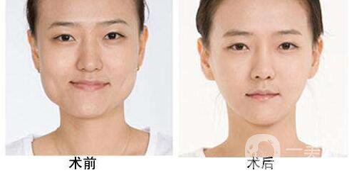 削骨,多少錢(qián),價(jià)格