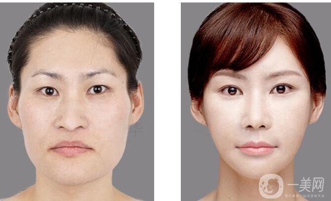 改臉型,醫(yī)院