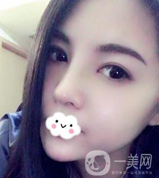 *隆鼻價(jià)格 *隆鼻需要多少錢(qián)