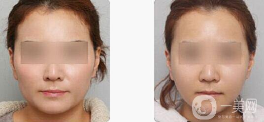 改臉型多少錢？ 改臉型需要多少錢？