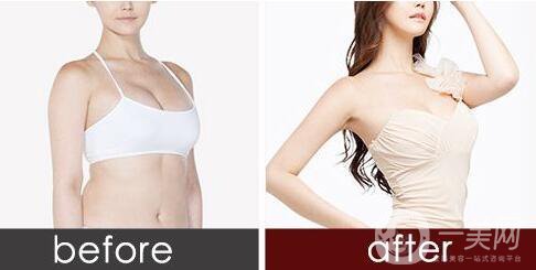 吸脂有危險嗎 吸脂危害有哪些