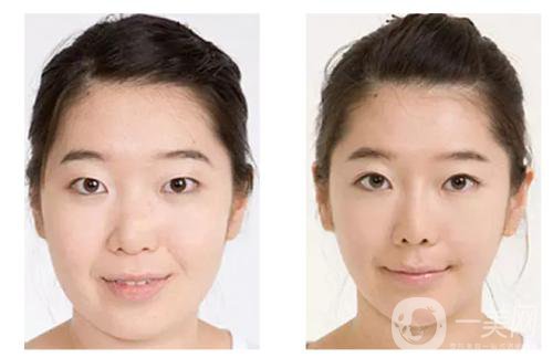 注射*的注意事項(xiàng)有些什么？