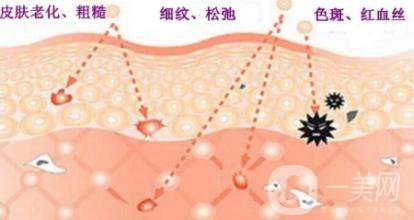 做光子嫩膚有什么作用和好處？