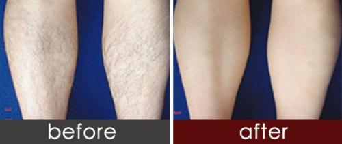 做激光脫毛價格大概是多少？