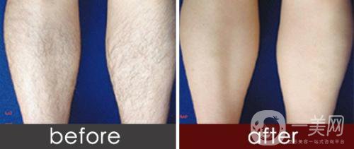 做激光脫毛價格大概是多少？