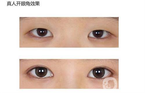 做開眼角手術(shù)需要多少錢？
