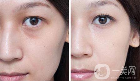 注射伊維蘭玻尿酸除皺多少錢？