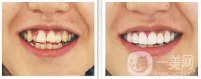 烤瓷牙的種類及價錢介紹、前后照片分享