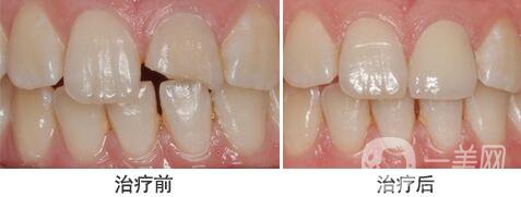 裝個(gè)烤瓷牙多少錢(qián)？烤瓷牙詳細(xì)價(jià)格介紹