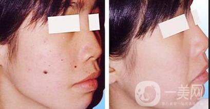 激光點痣大概多少錢？激光祛痣的價格詳解