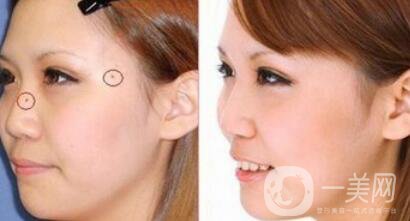 激光點痣大概多少錢？激光祛痣的價格詳解