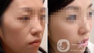 去皺多少錢？除皺價(jià)格詳細(xì)介紹