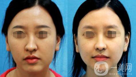 歪鼻矯正需要多少錢？上海歪鼻矯正價(jià)格詳解