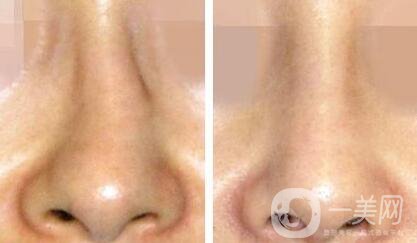 歪鼻矯正需要多少錢？上海歪鼻矯正價(jià)格詳解