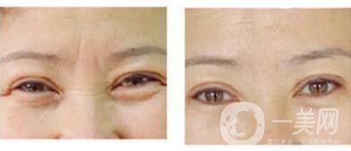 眉間皺紋如何去除？眉間川字紋怎么才能去掉