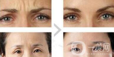 眉間皺紋如何去除？眉間川字紋怎么才能去掉