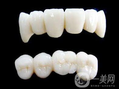 烤瓷牙,價格