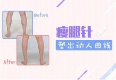 注射瘦腿會(huì)反彈嗎 注射瘦腿果維持多久